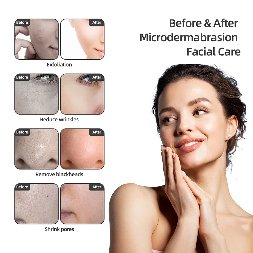 Foreverlily Spa Facial Peeling Deep Cleansing Device Pore Cleaning